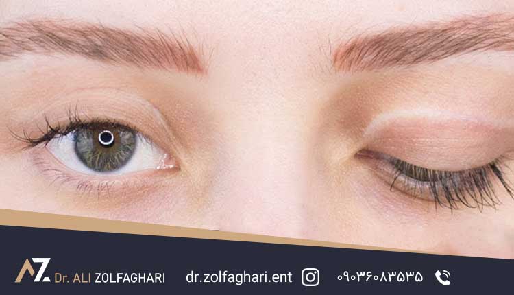 دلایل بازماندن چشم بعد از عمل جراحی بلفاروپلاستی