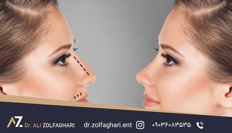عمل بینی عروسکی چیست؟