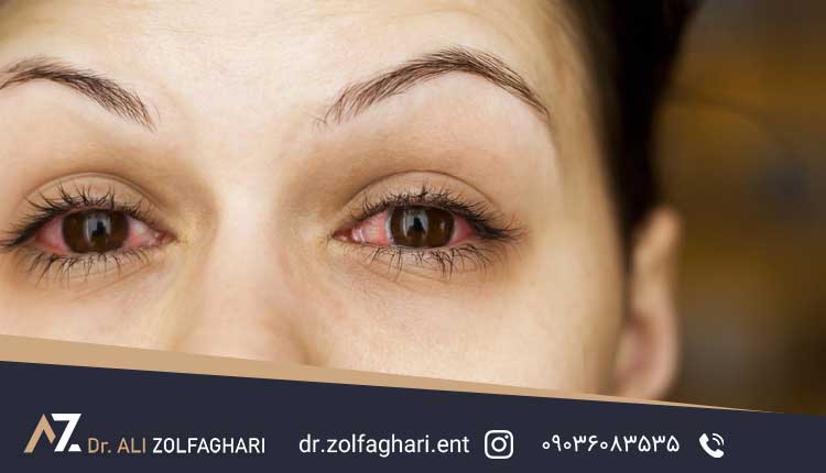 درمان های خانگی سوزش چشم بعد از عمل بینی