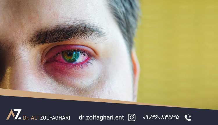 سوزش چشم بعد از عمل بینی
