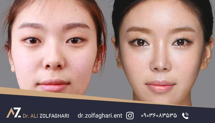 ملاحظات قبل از تصمیم گیری برای انجام جراحی بینی | تغییر چهره بعد از عمل بینی
