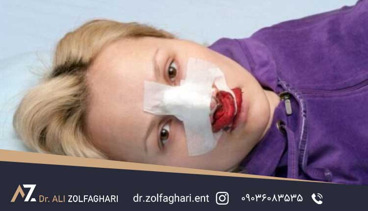 10 علت عمل بینی ناموفق | چرا عمل بینی با شکست مواجه می شود؟