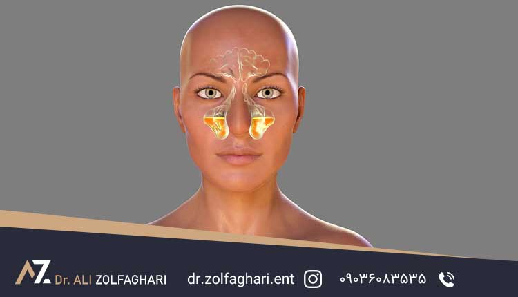 راه های درمان سینوزیت قارچی