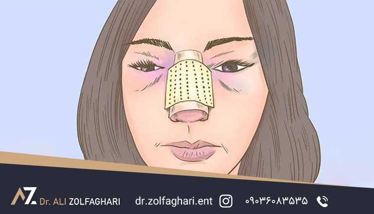 مقابله با کبودی بعد از عمل بینی
