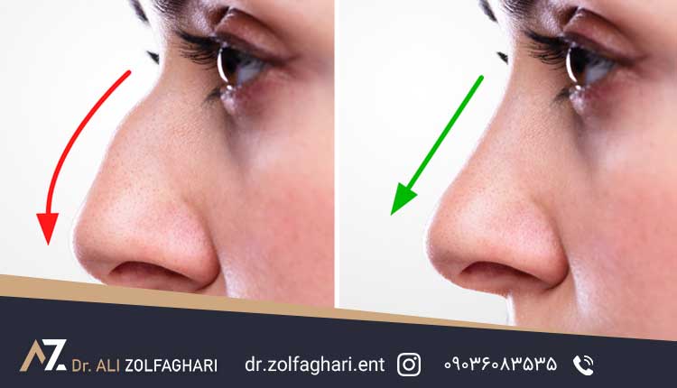رینوپلاستی (جراحی بینی)