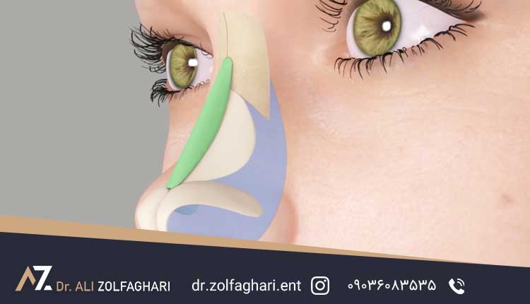 آشنایی با بینی زینی شکل و راه اصلاح آن