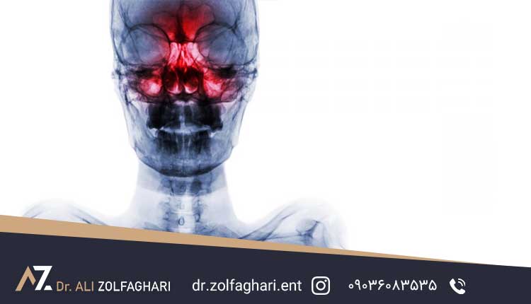 علائم تومور های بینی و سینوس