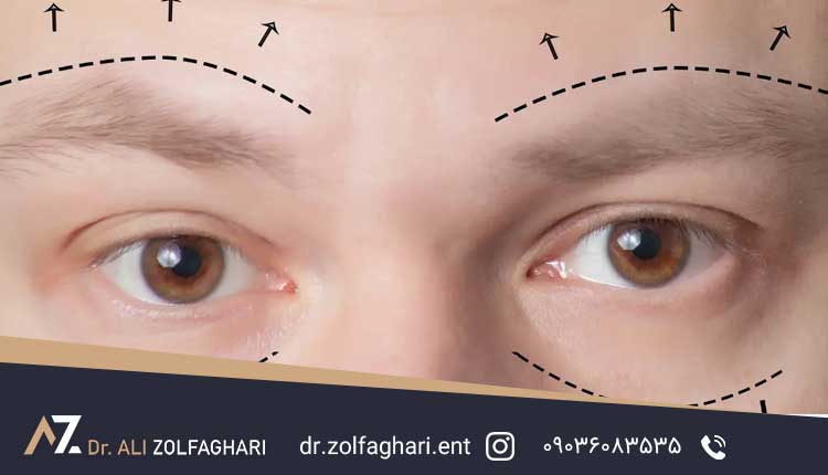 قبل از جراحی پلک