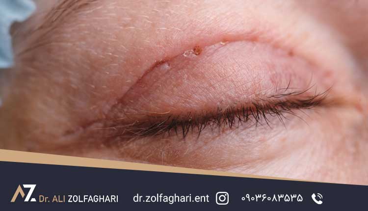 چگونه از ایمنی جراحی پلک بالا اطمینان حاصل کنیم؟