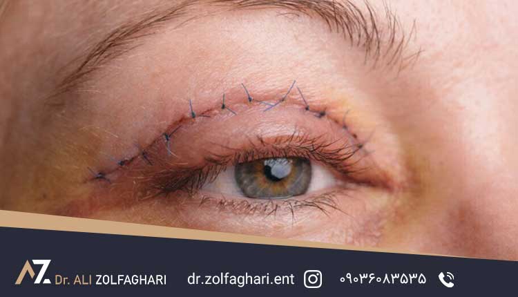 باید و نباید های ورزش بعد از عمل پلک