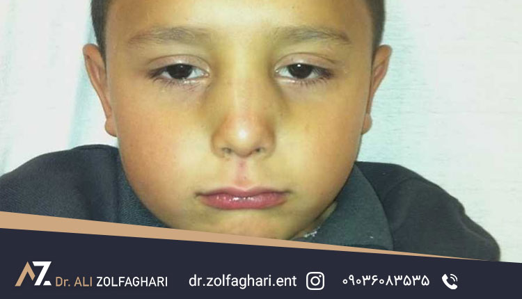 بینی شکسته کودک ، عوارض و راه های جلوگیری از آن