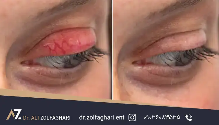 تشخیص گوشت اضافه بعد از بلفاروپلاستی