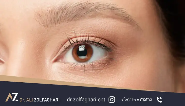 کوچک شدن چشم بعد از جراحی بلفاروپلاستی
