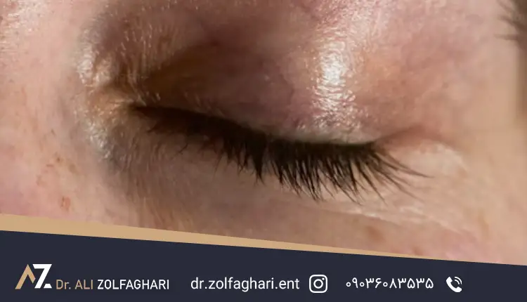 خشکی چشم بعد از عمل بلفاروپلاستی