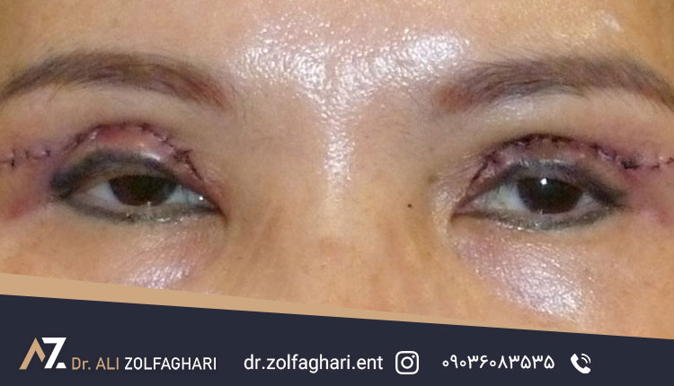 گوشت اضافه روی پلک بعد از بلفاروپلاستی