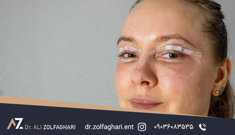 کرم ‌برای گوشت اضافه بعد از بلفاروپلاستی