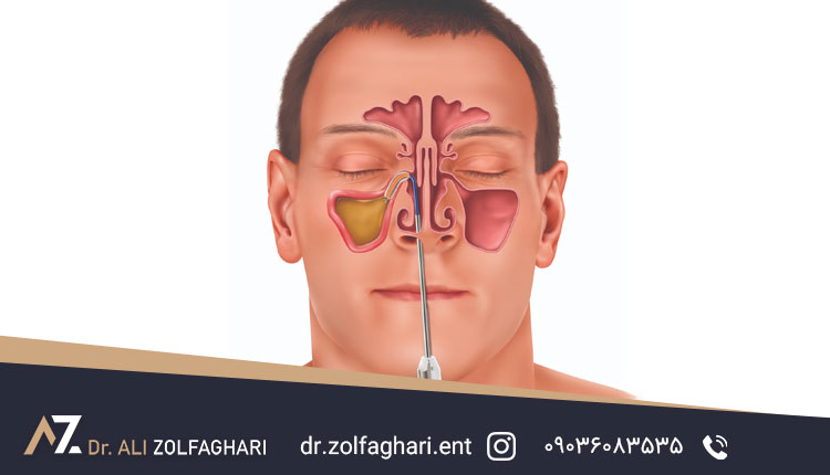 علائم تنگی دریچه بینی