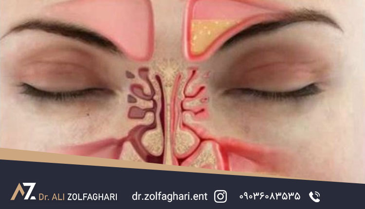 تنگی مجرای بینی چگونه درمان میشود؟