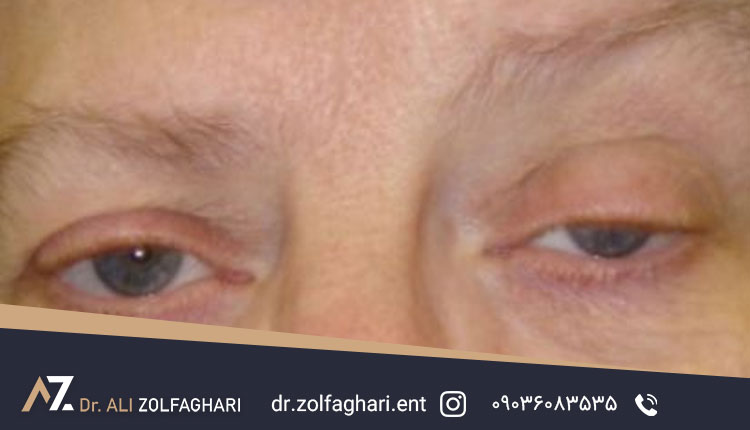 آیا کوچک شدن چشم بعد از بلفاروپلاستی قابل درمان است؟