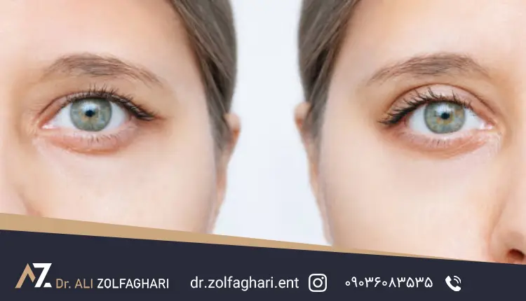 آیا بوتاکس بعد از عمل پلک امکان پذیر است؟