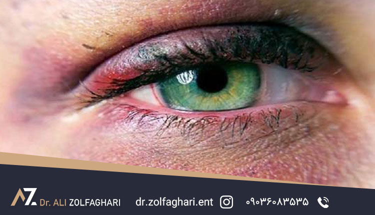 کبودیهای زیرپوستی