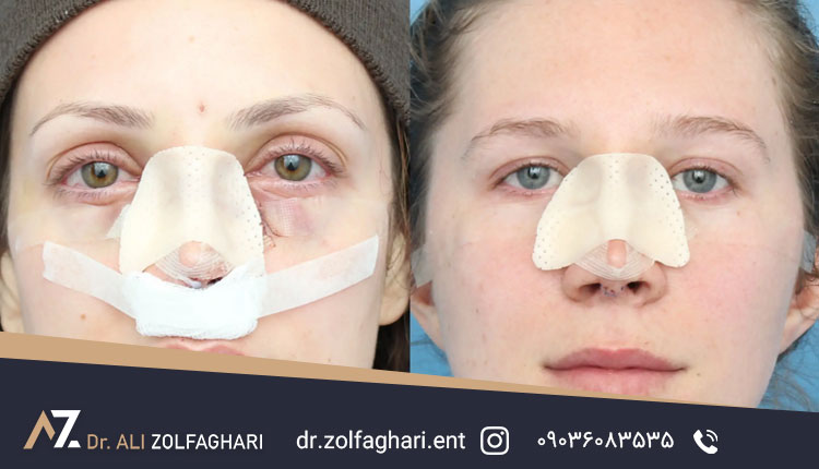 عوامل موثر در میزان کبودی پس از عمل رینوپلاستی