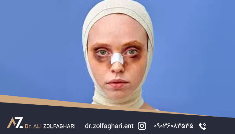 کبودی بعد از جراحی بینی و راه ها رفع آن