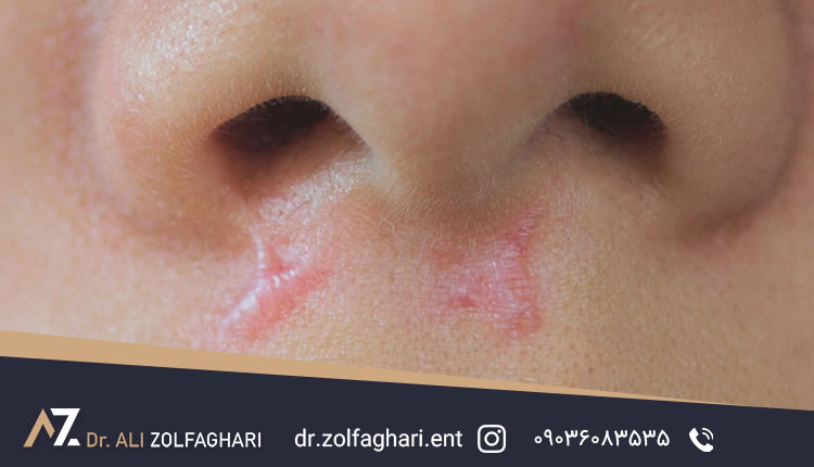 علت مؤثر در کلوئید یا گوشت اضافه بعد از عمل بینی