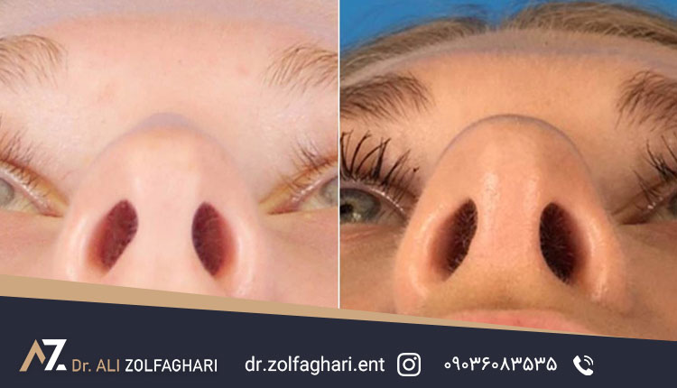 علت گوشت اضافه داخل بینی بعد از عمل بینی
