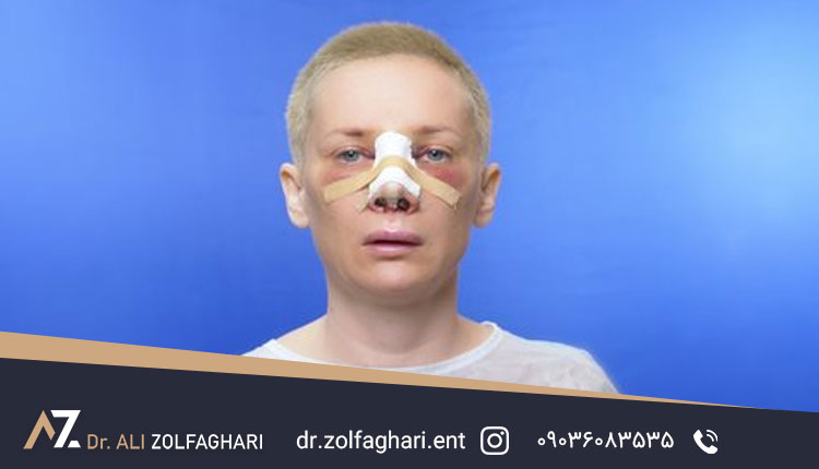 برای رفع ورم صورت بعد از عمل بینی چه بخوریم ؟