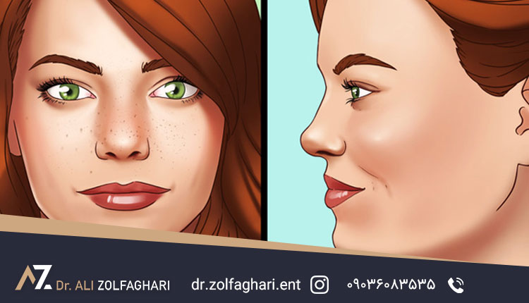 بینی استخوانی بعد از عمل بیشتر ورم میکند یا بینی گوشتی؟