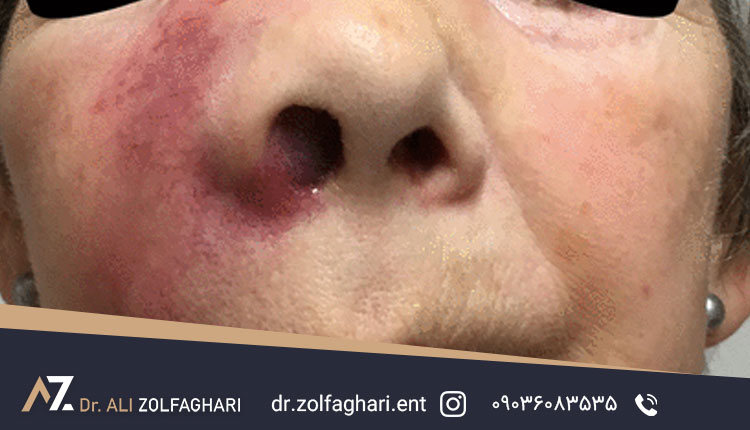 عکس ورم یکطرفه بینی بعد از عمل بینی