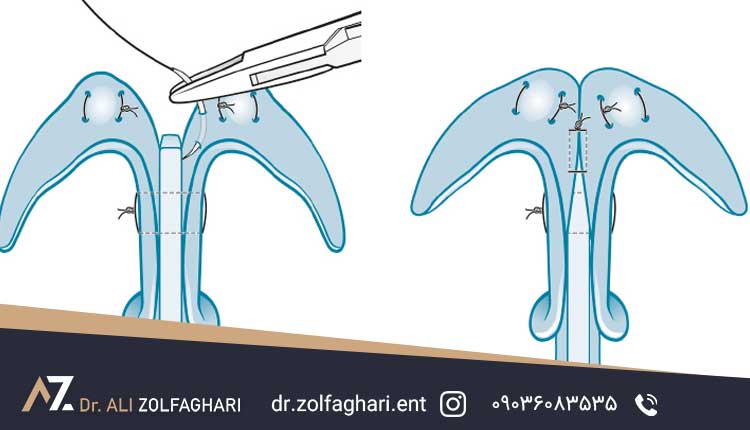 تاثیر بخیه بر سوزش بینی بعد از عمل