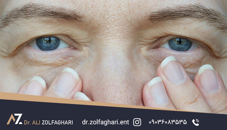 دلیل افتادگی پلک چیست؟