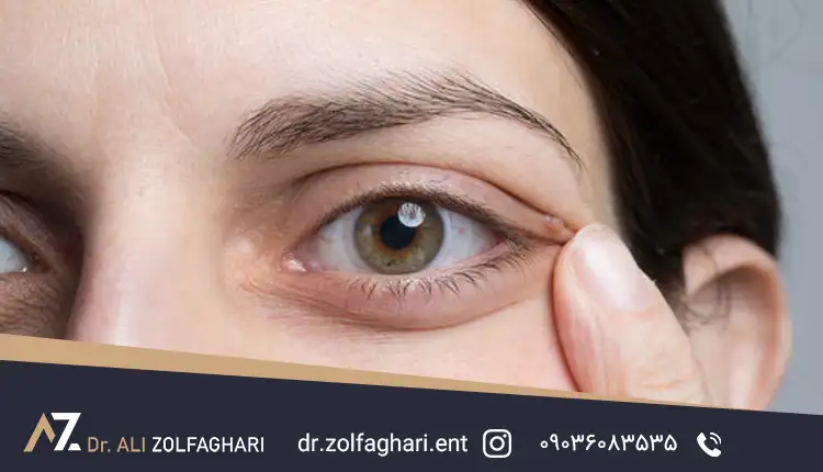 نکات کلیدی درباره سن مناسب برای عمل بلفاروپلاستی