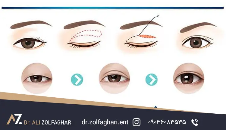 افتادگی پلک با جراحی