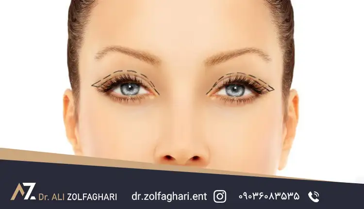 جراحی بلفاروپلاستی چیست