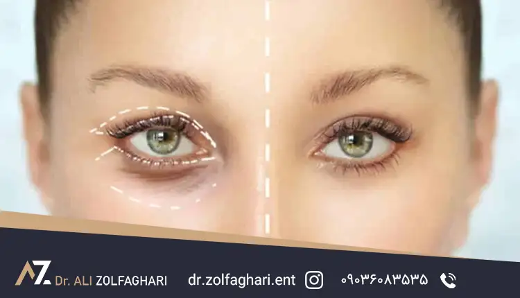 مراحل انجام عمل بلفاروپلاستی