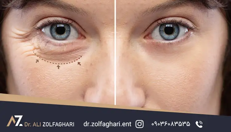 بلفاروپلاستی پلک پایین