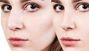 خطرات احتمالی جراحی بینی برای بیماران قلبی