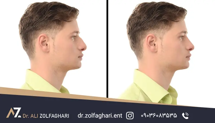 عمل بینی مردان
