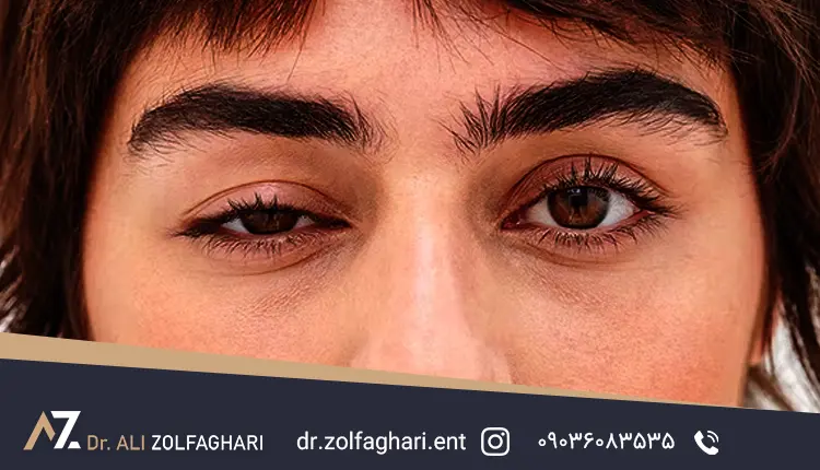 افتادگی پلک عصبی