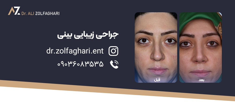 عکس قبل و بعد جراحی رینوپلاستی دکتر ذوالفقاری