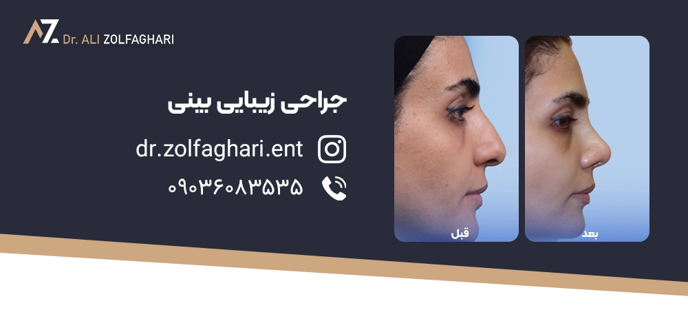 عمل رینوپلاستی بینی استخوانی