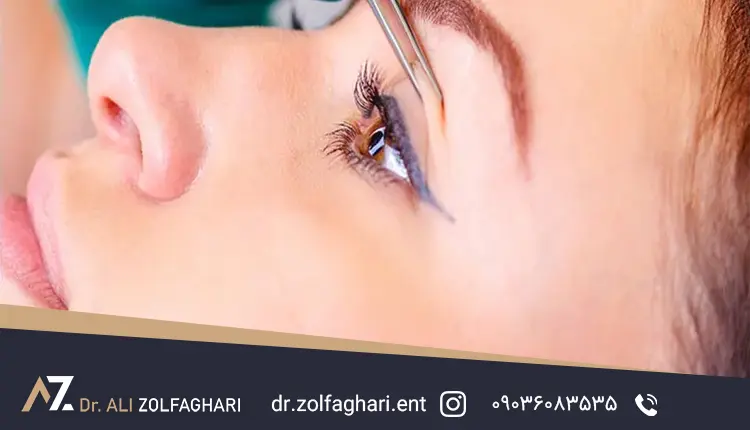 هزینه عمل بلفاروپلاستی