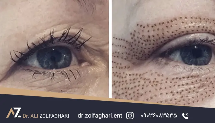 هزینه بلفاروپلاستی با لیزر