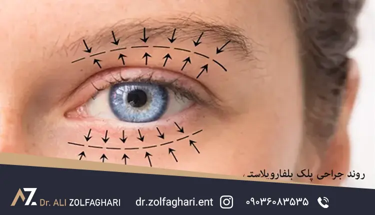هزینه بلفاروپلاستی پلک بالا