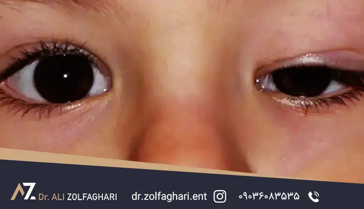 افتادگی پلک در نوزادان