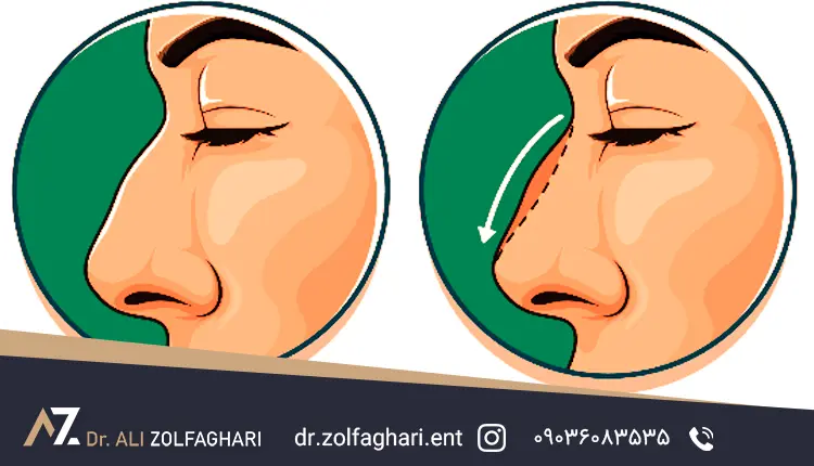 عمل جراحی بینی
