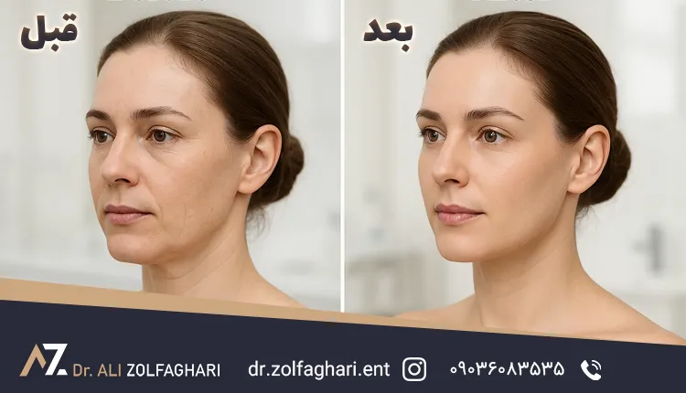 تصاویر هایفوتراپی صورت